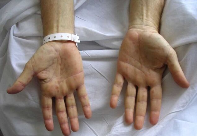 Syphilis in hands as the cause of pathological discharge from the genitals